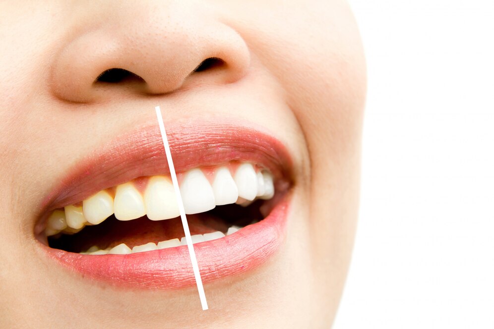 Amazing Benefits of Getting a Professional Teeth Whitening Treatment