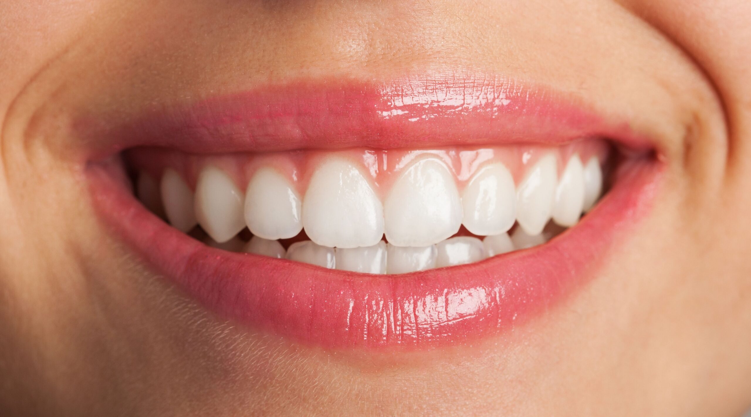 What Precautions Should I Take After Teeth Whitening?